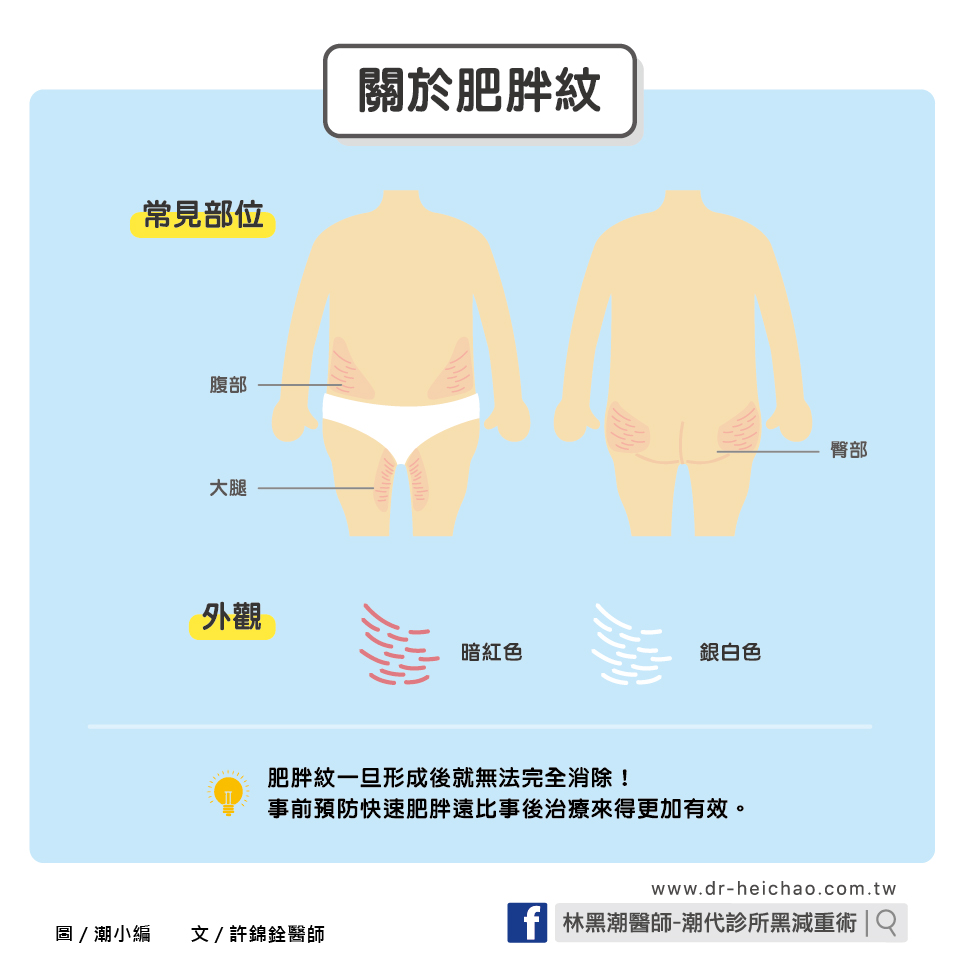 快速肥胖，小心肥胖紋糾纏／文：許錦銓醫師