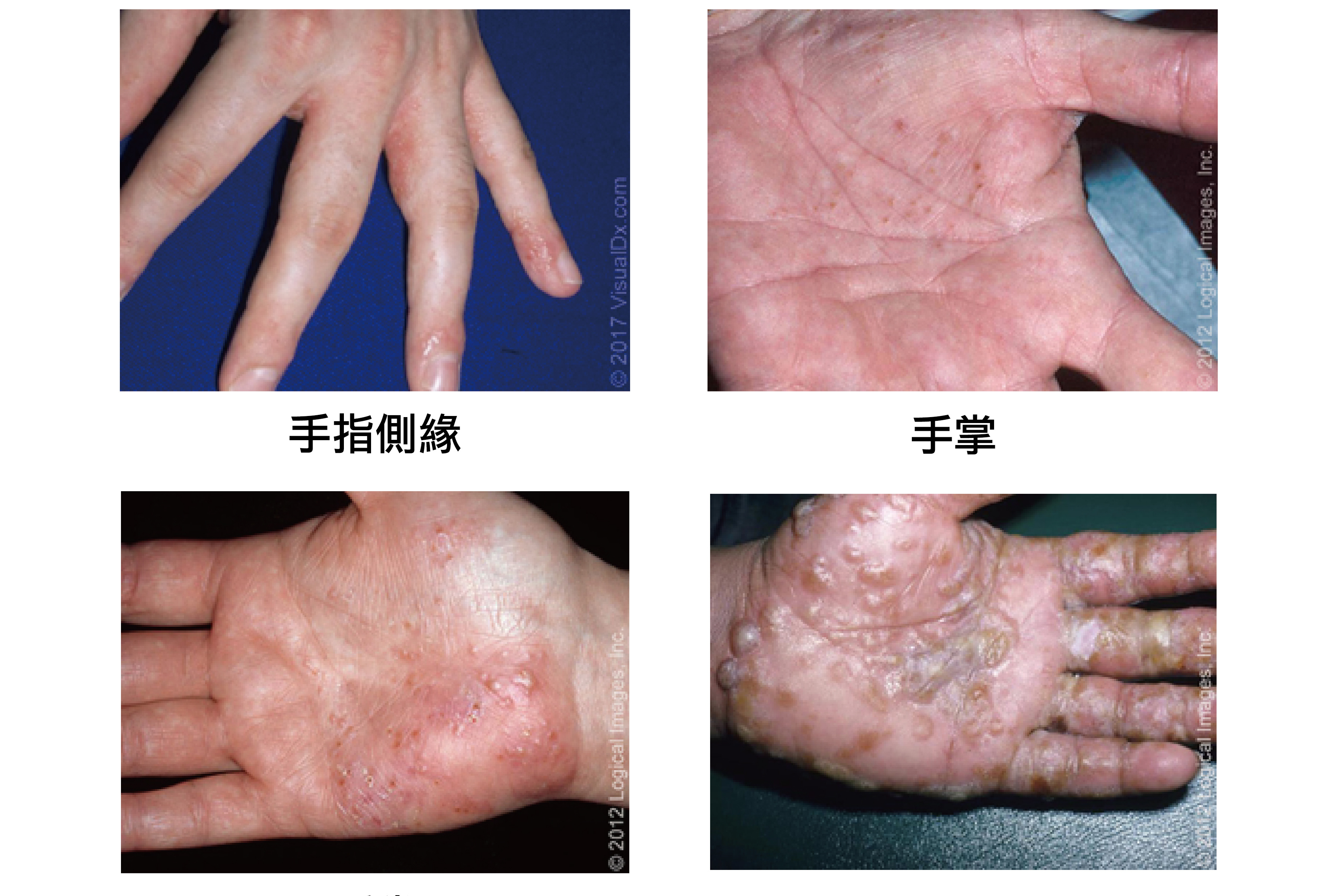 汗皰疹／文：黃瀚霆醫師