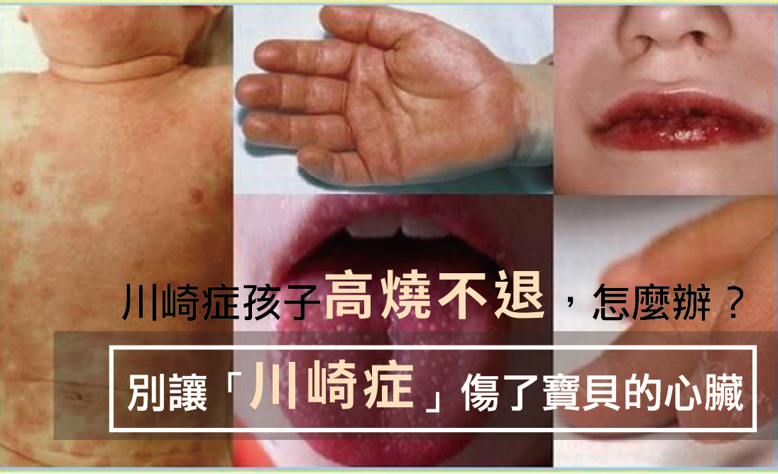 川崎症是什麼？幼兒發燒別大意！／文：許錦銓醫師