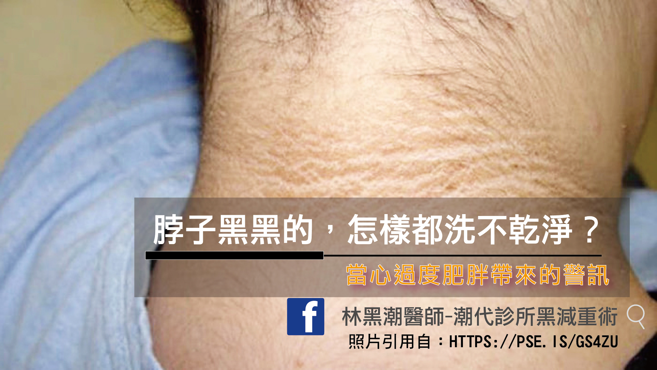 你不可不知的健康厚黑學：黑色棘皮症／文：黃瀚霆醫師