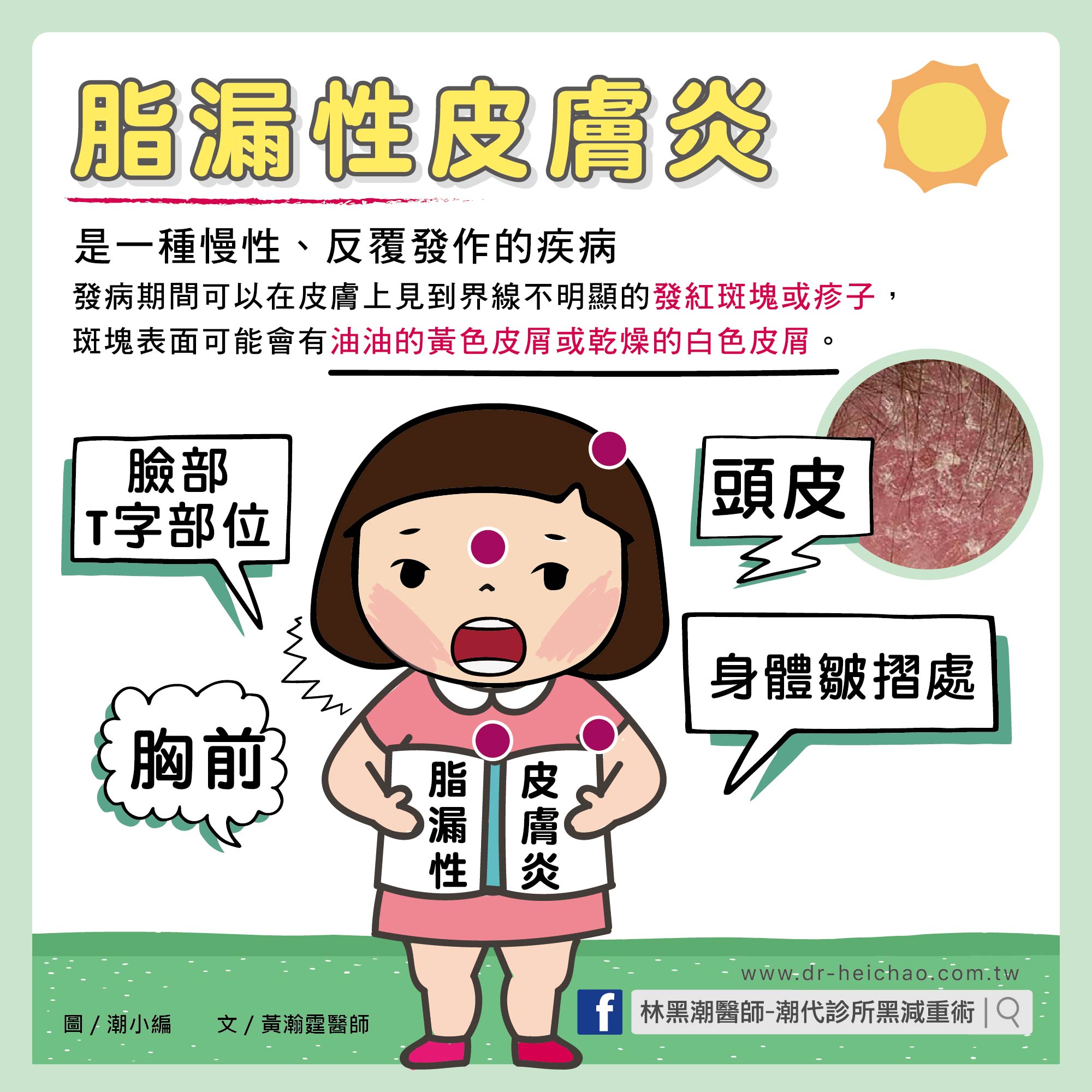 脂漏性皮膚炎/文:黃瀚霆醫師