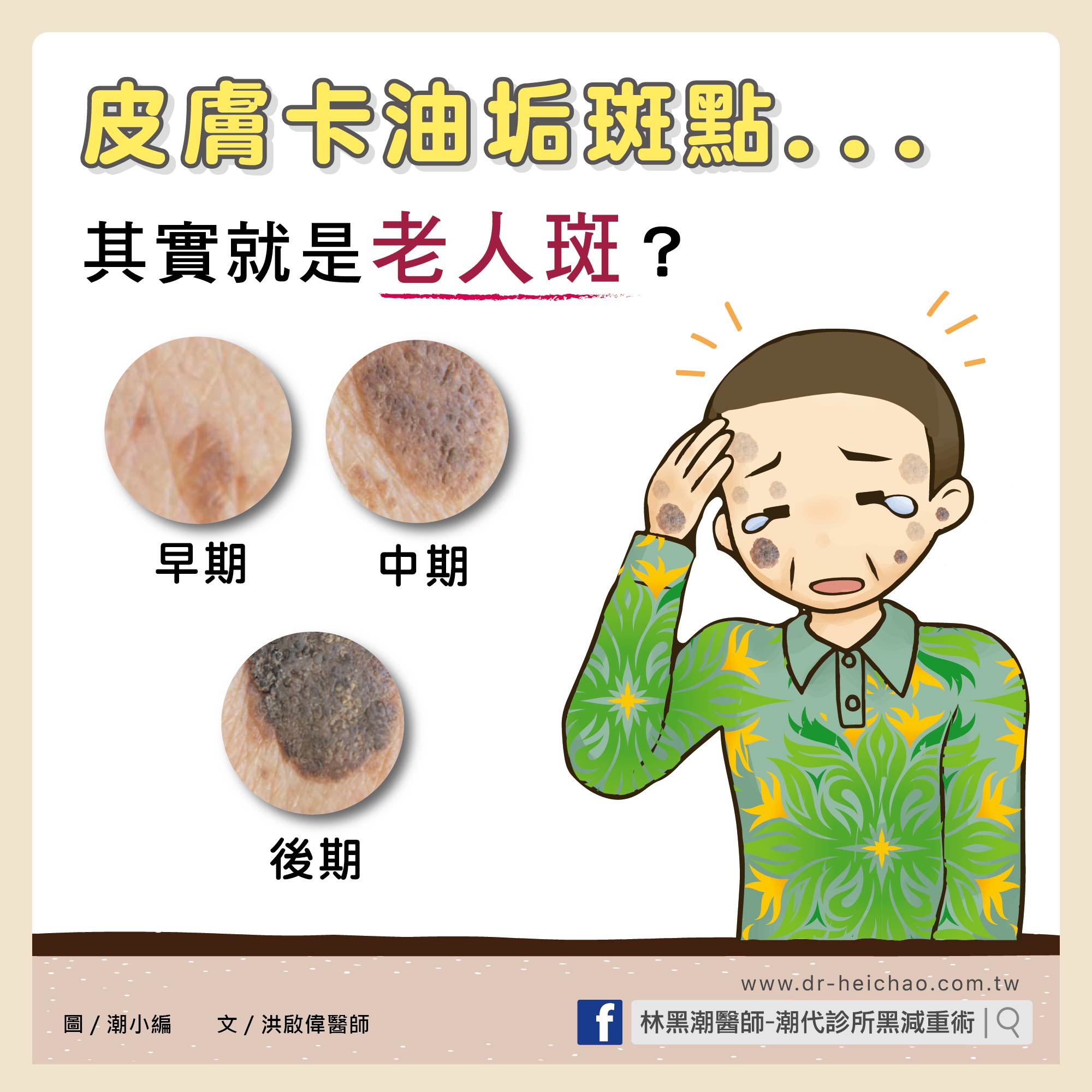 皮膚卡油垢斑點其實就是老人斑/文:洪啟偉醫師