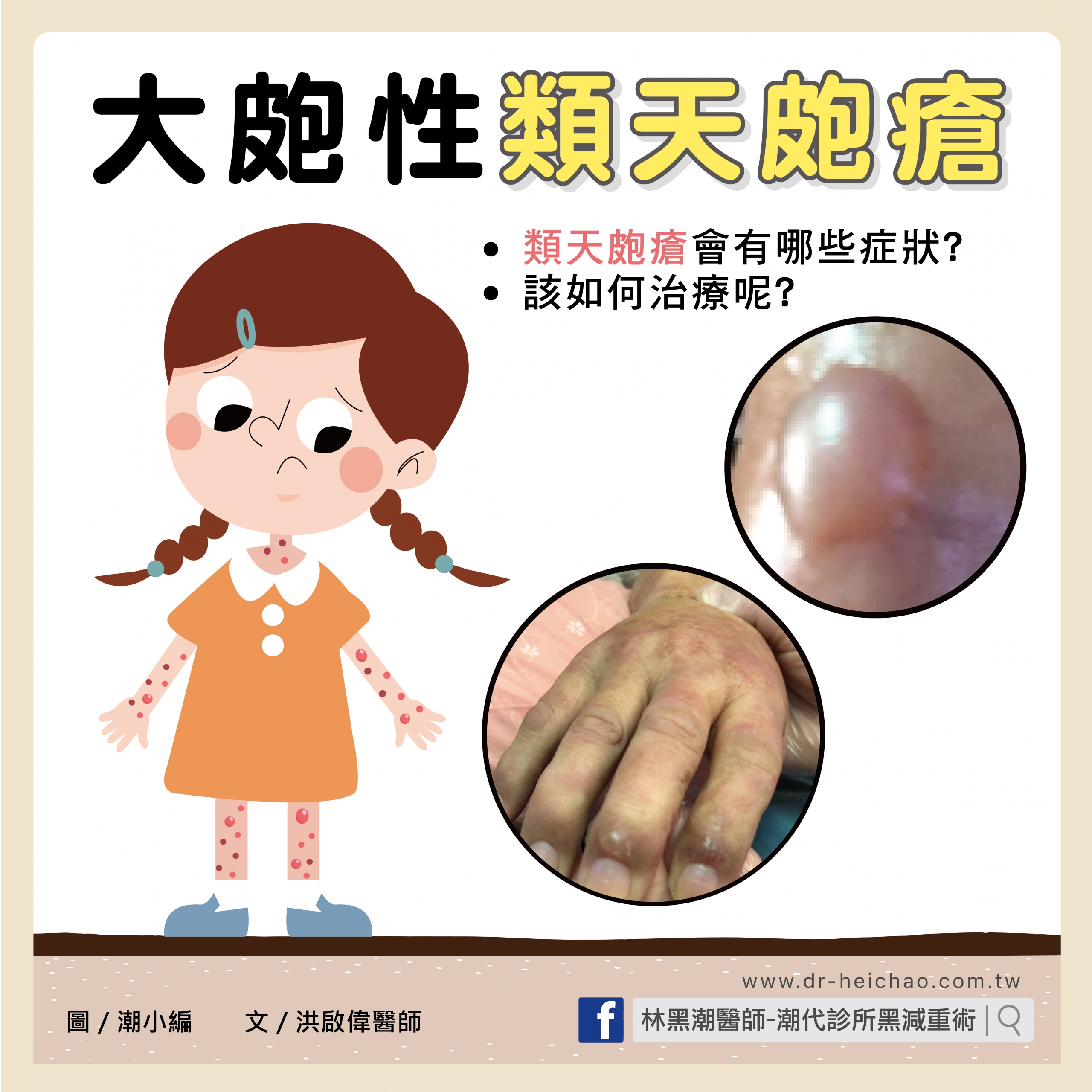 大皰性類天皰瘡/文:洪啟偉醫師