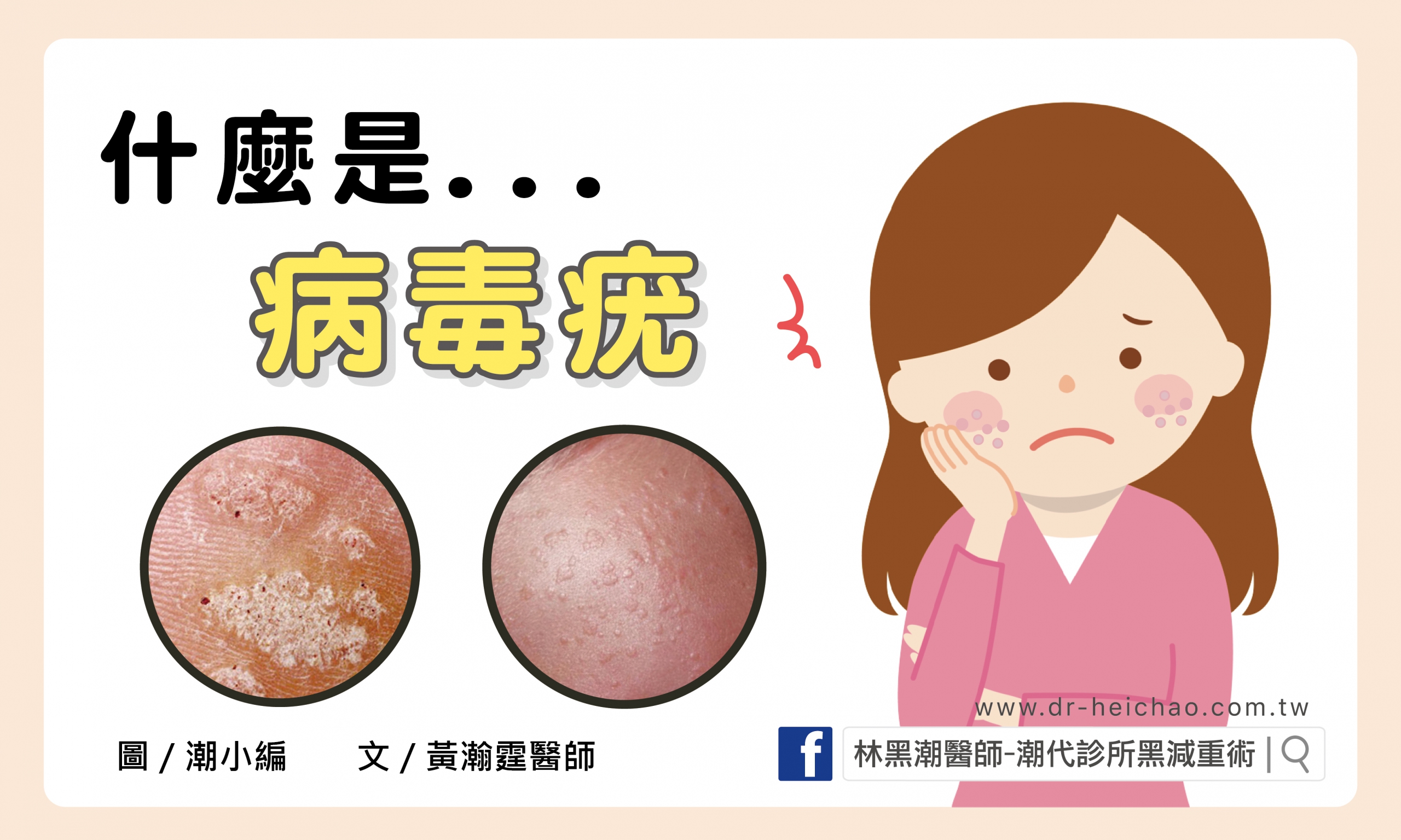 病毒疣/文:黃瀚霆醫師