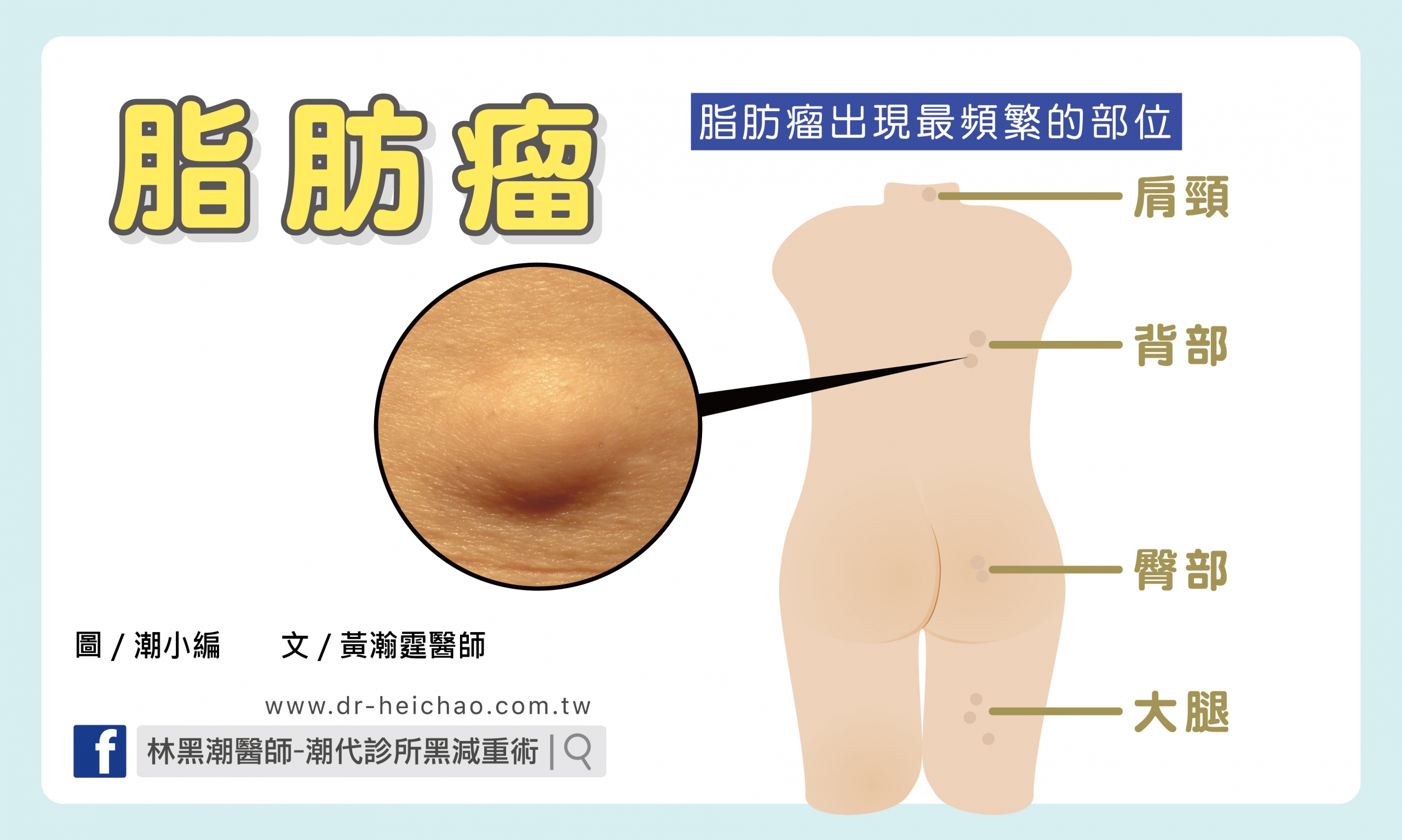 脂肪瘤／文：黃瀚霆醫師
