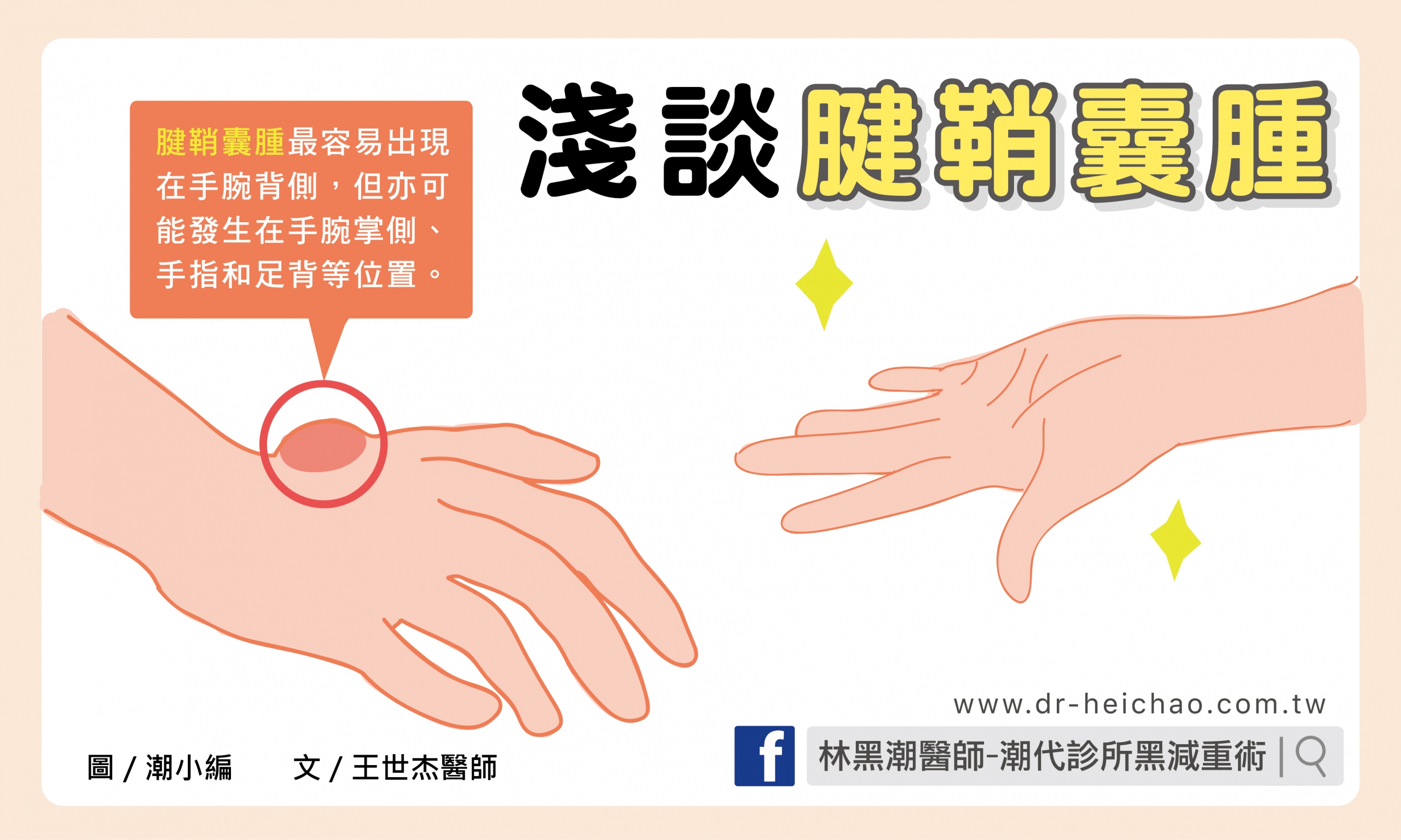 淺談腱鞘囊腫/文:王世杰醫師