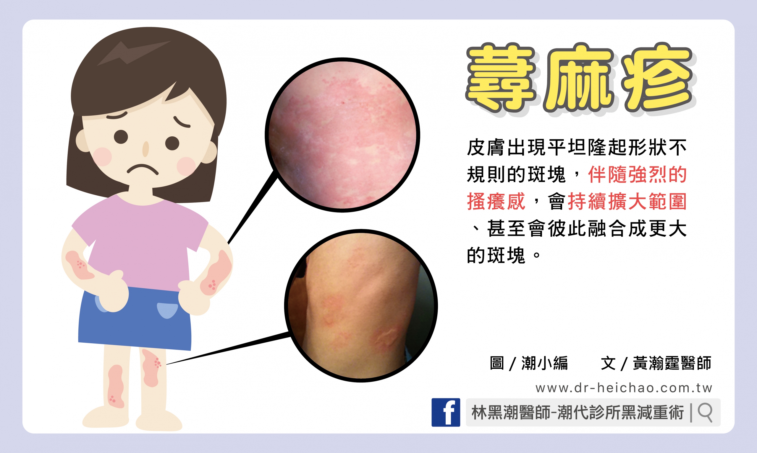 蕁麻疹／文：黃瀚霆醫師
